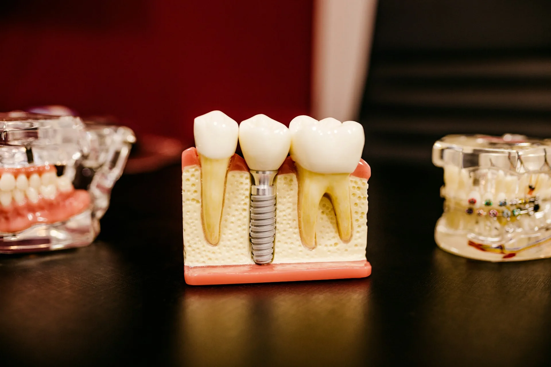 A cross-section dental model showing an implant set between two natural back teeth, used to explain treatment